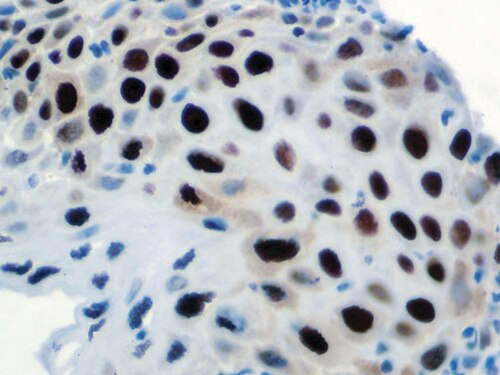 IHC of Topo IIa on an FFPE HSIL of the Cervix